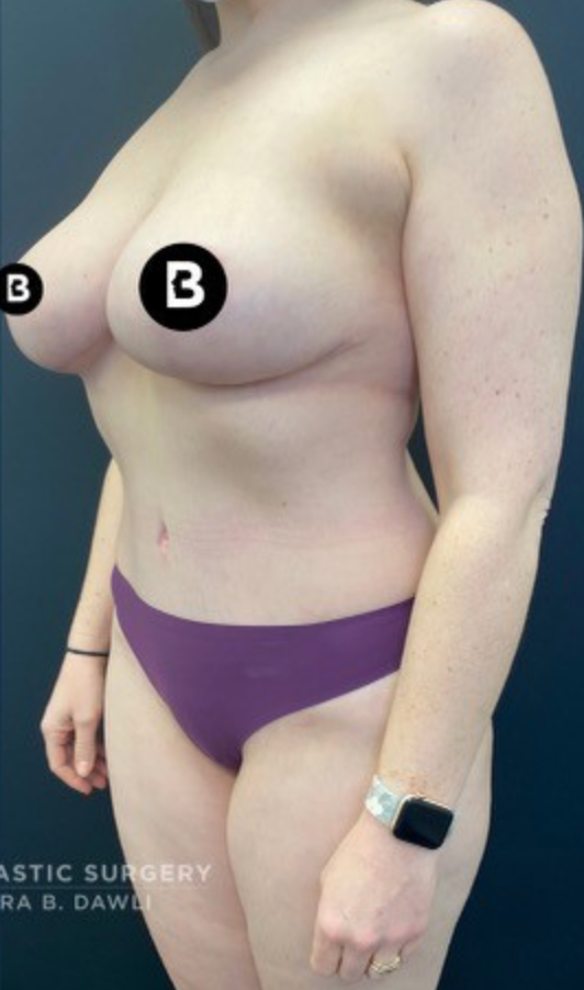 Buffalo Plastic Surgery mommy makeover after — Amherst, NY