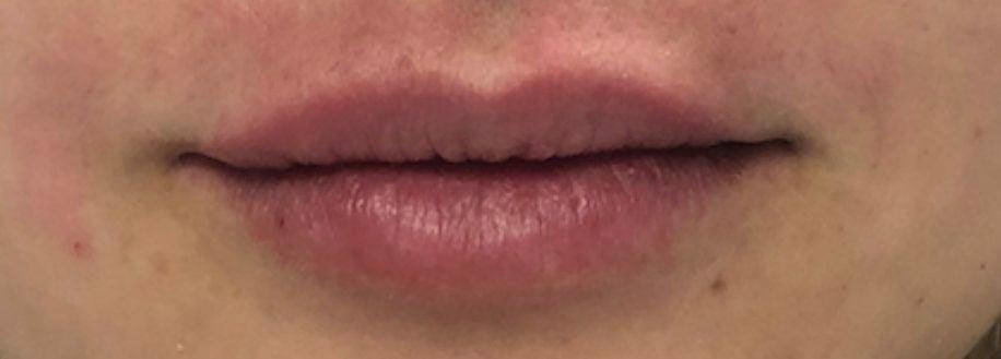 Buffalo Plastic Surgery lip filler result — Amherst, NY