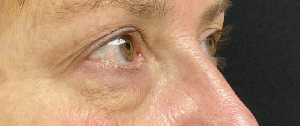 Buffalo Plastic Surgery blepharoplasty result — Amherst, NY