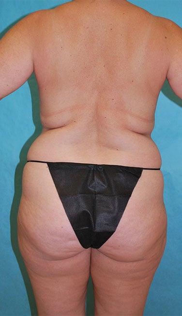Liposuction before at Buffalo Plastic Surgery in Amherst, NY