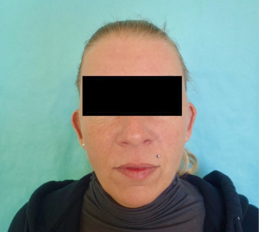 Buffalo Plastic Surgery otoplasty after — Amherst, NY