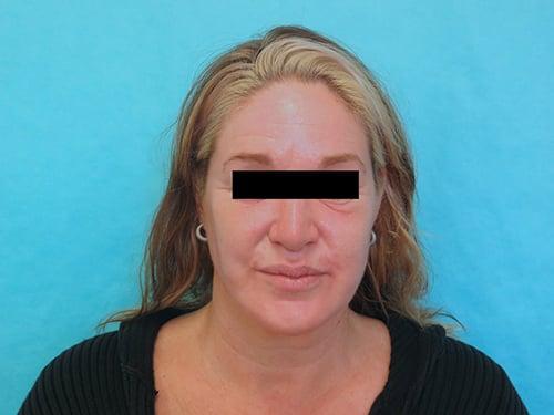 Deep Plane Facelift before at Buffalo Plastic Surgery in Amherst, NY