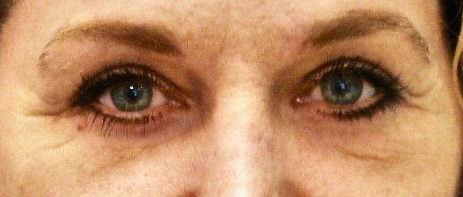Buffalo Plastic Surgery blepharoplasty after — Amherst, NY