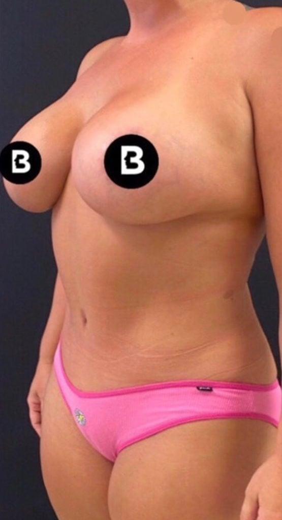 Buffalo Plastic Surgery mommy makeover after — Amherst, NY