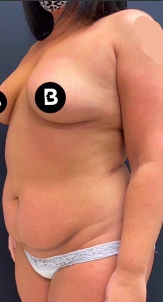Mommy Makeover before at Buffalo Plastic Surgery in Amherst, NY
