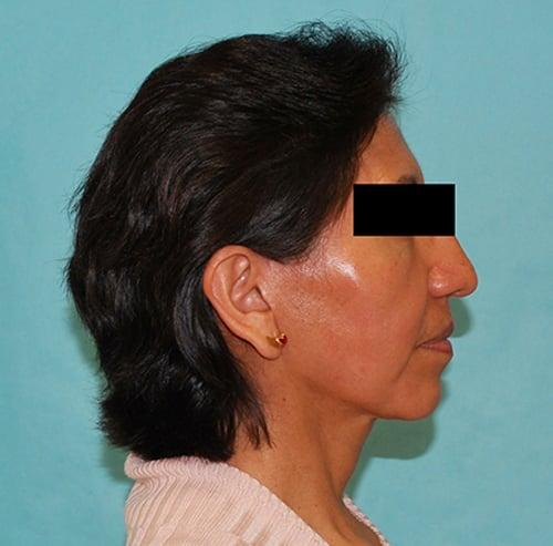 Buffalo Plastic Surgery facelift after — Amherst, NY