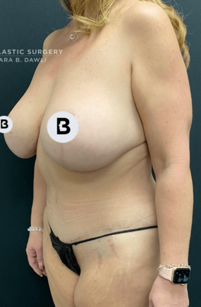 Buffalo Plastic Surgery mommy makeover after — Amherst, NY