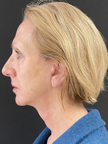 Deep Plane Facelift after at Buffalo Plastic Surgery in Amherst, NY