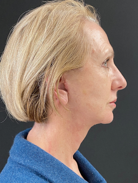 Deep Plane Facelift after at Buffalo Plastic Surgery in Amherst, NY
