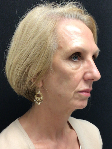 Deep Plane Facelift before at Buffalo Plastic Surgery in Amherst, NY