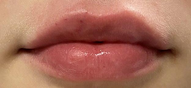 Buffalo Plastic Surgery lip filler after — Amherst, NY
