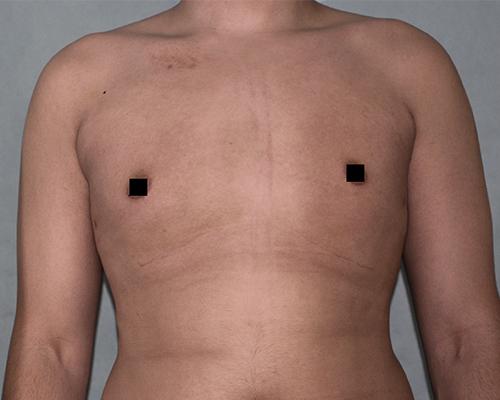 Buffalo Plastic Surgery gynecomastia after — Amherst, NY
