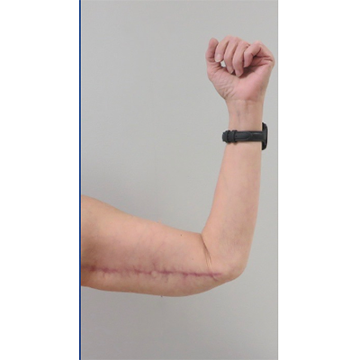 Arm Lift after at Buffalo Plastic Surgery in Amherst, NY