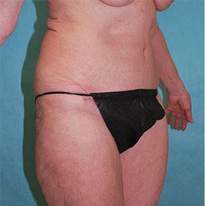 Buffalo Plastic Surgery tummy tuck after — Amherst, NY