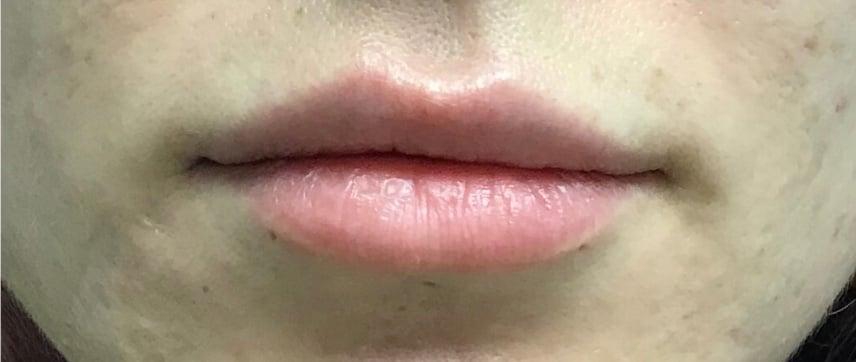 Buffalo Plastic Surgery lip filler result — Amherst, NY