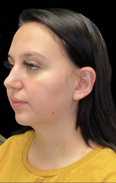 Fat Transfer after at Buffalo Plastic Surgery in Amherst, NY