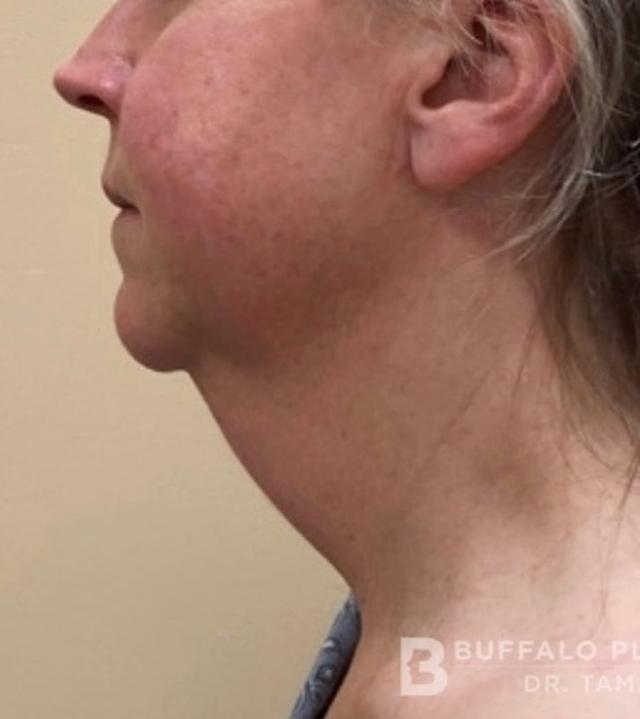 Neck Lift before at Buffalo Plastic Surgery in Amherst, NY