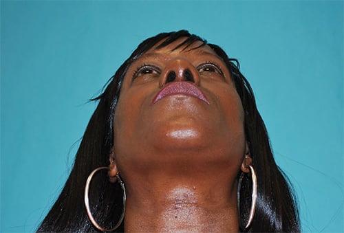 Rhinoplasty after at Buffalo Plastic Surgery in Amherst, NY