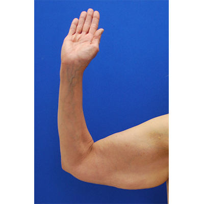 Arm Lift before at Buffalo Plastic Surgery in Amherst, NY