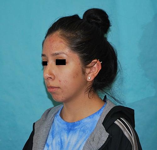 Buffalo Plastic Surgery rhinoplasty after — Amherst, NY