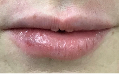 Buffalo Plastic Surgery lip filler after — Amherst, NY