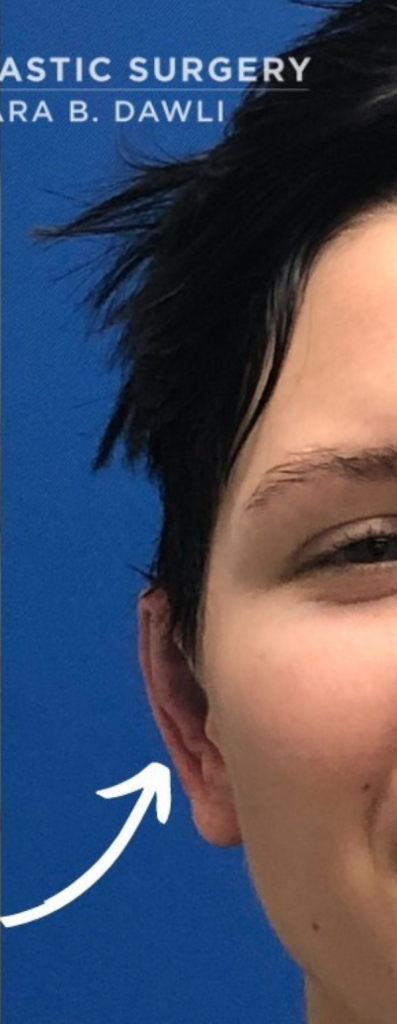 Buffalo Plastic Surgery otoplasty after — Amherst, NY