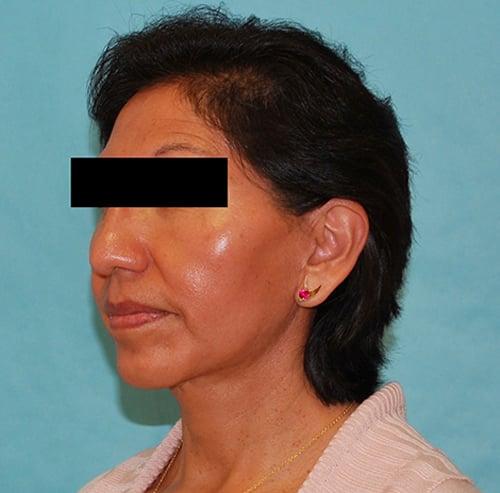 Buffalo Plastic Surgery facelift after — Amherst, NY