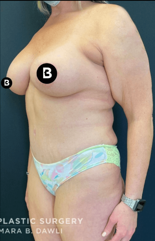 Buffalo Plastic Surgery mommy makeover after — Amherst, NY