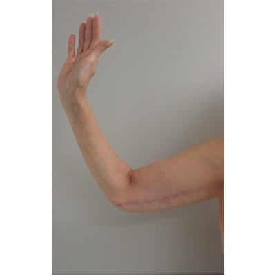 Arm Lift after at Buffalo Plastic Surgery in Amherst, NY