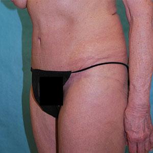 Buffalo Plastic Surgery tummy tuck after — Amherst, NY