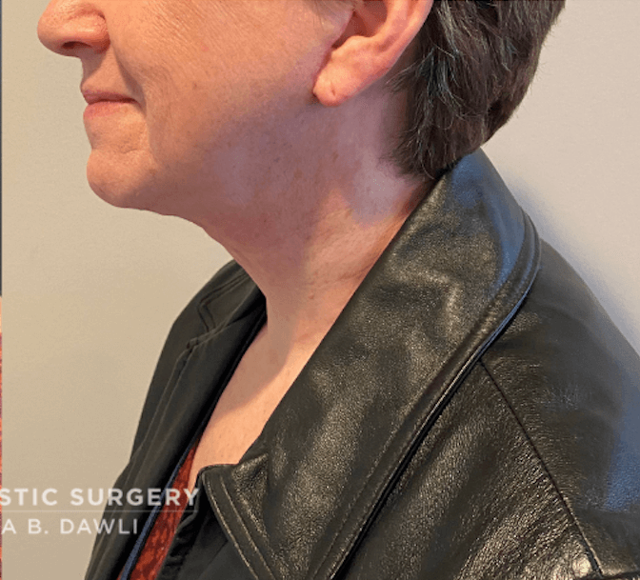 Neck Lift after at Buffalo Plastic Surgery in Amherst, NY