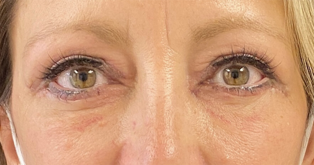 Buffalo Plastic Surgery blepharoplasty result — Amherst, NY