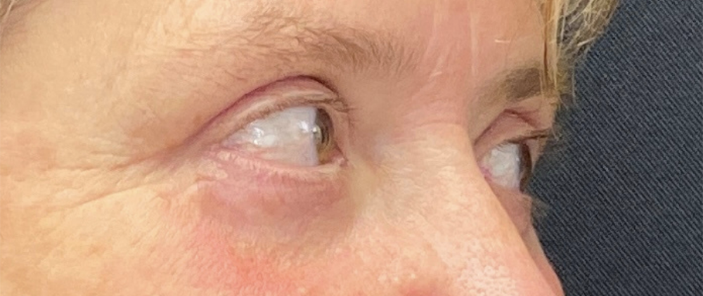 Buffalo Plastic Surgery blepharoplasty result — Amherst, NY