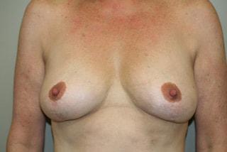 Keith Denkler, MD breast lift after — Larkspur, CA