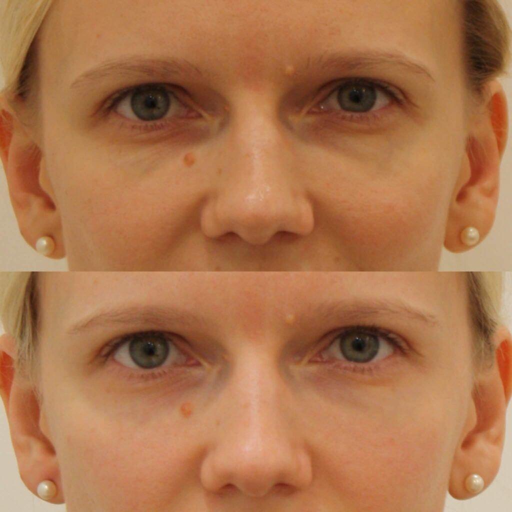 Anita Kulkarni, MD under-eye filler result — Washington, DC
