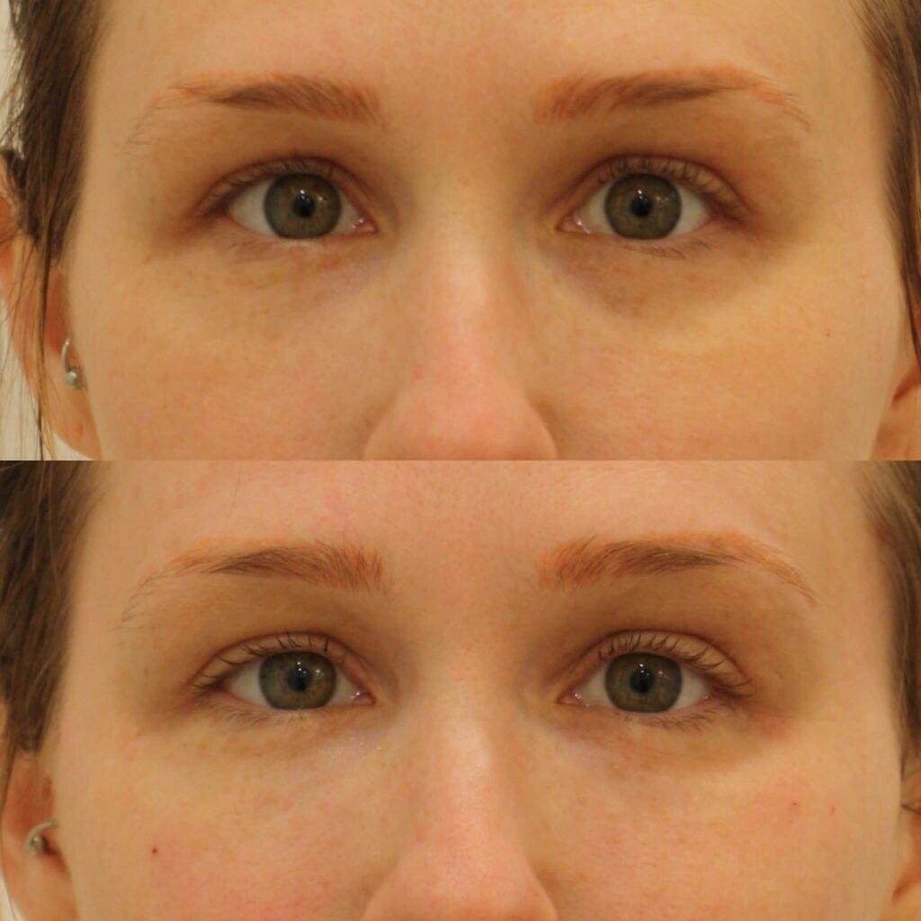 Anita Kulkarni, MD under-eye filler result — Washington, DC