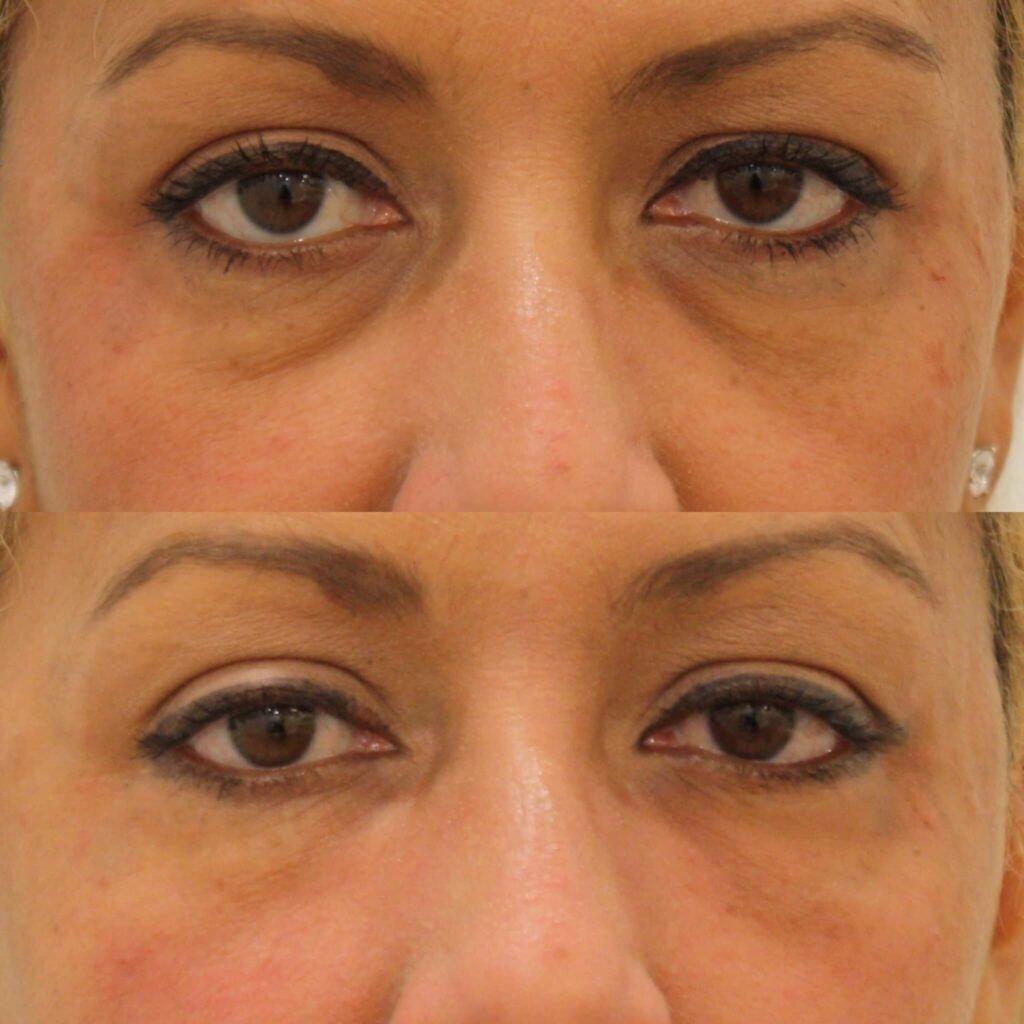 Anita Kulkarni, MD under-eye filler result — Washington, DC
