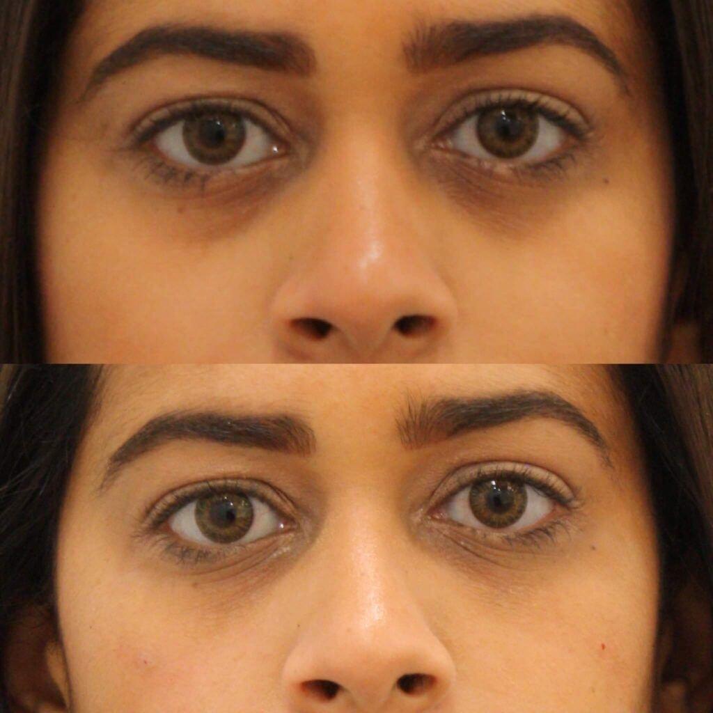 Anita Kulkarni, MD under-eye filler result — Washington, DC