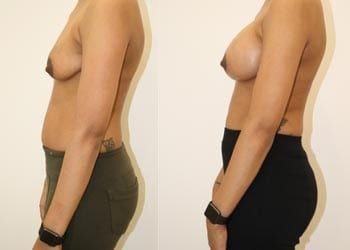 Breast Lift result at Anita Kulkarni, MD in Washington, DC