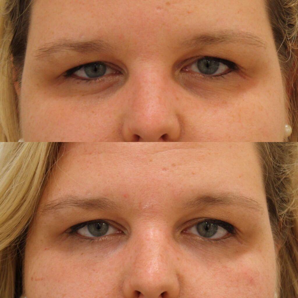 Anita Kulkarni, MD under-eye filler result — Washington, DC