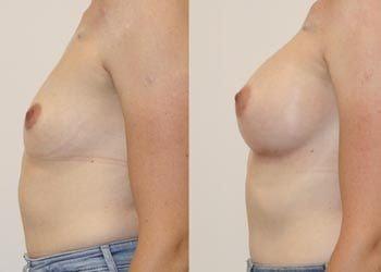 Breast Lift result at Anita Kulkarni, MD in Washington, DC