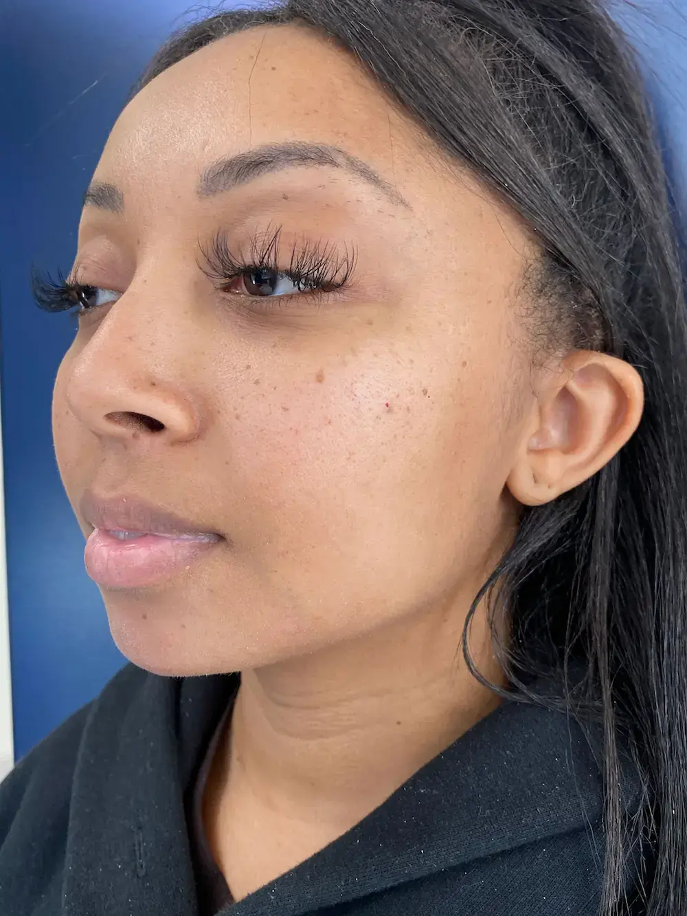 Capital Aesthetic and Laser Center after — Washington, DC