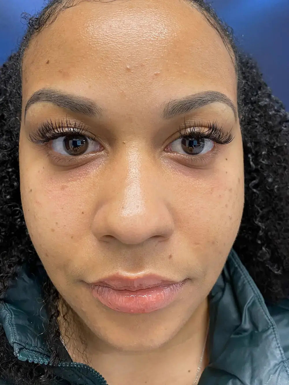 Capital Aesthetic and Laser Center after — Washington, DC