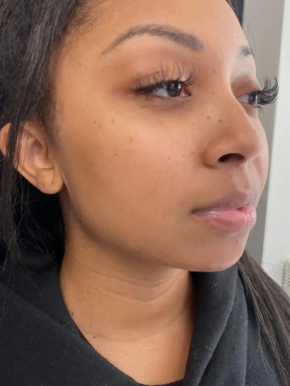 Capital Aesthetic and Laser Center after — Washington, DC