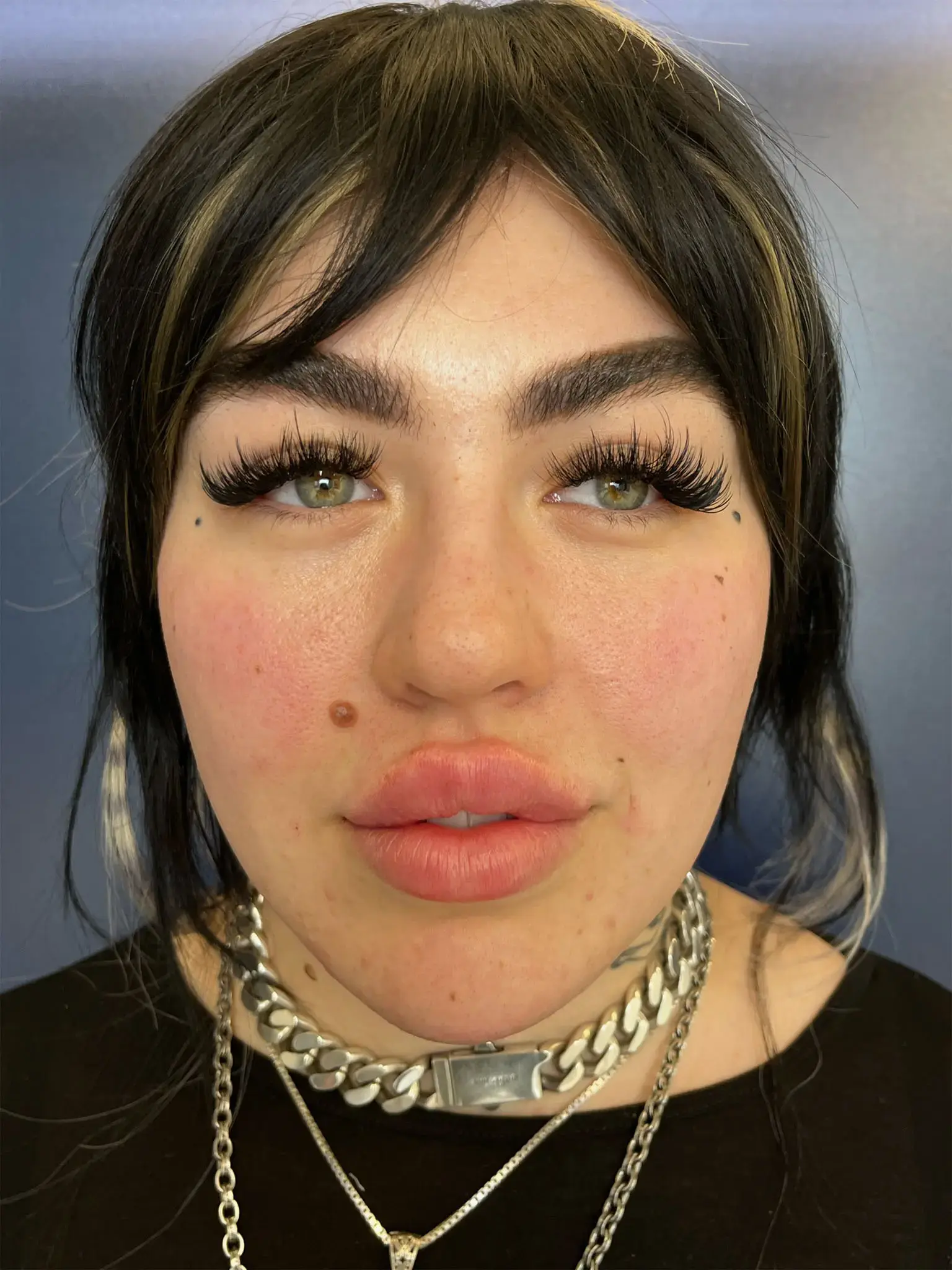 Capital Aesthetic and Laser Center after — Washington, DC