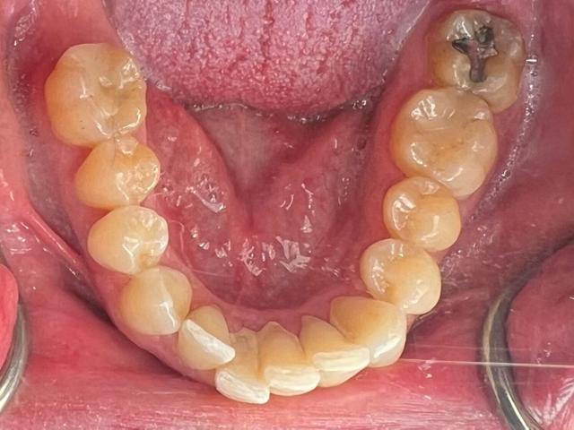 Gum Contouring before at Kierland Dental Studio of Paradise Valley in Scottsdale, AZ
