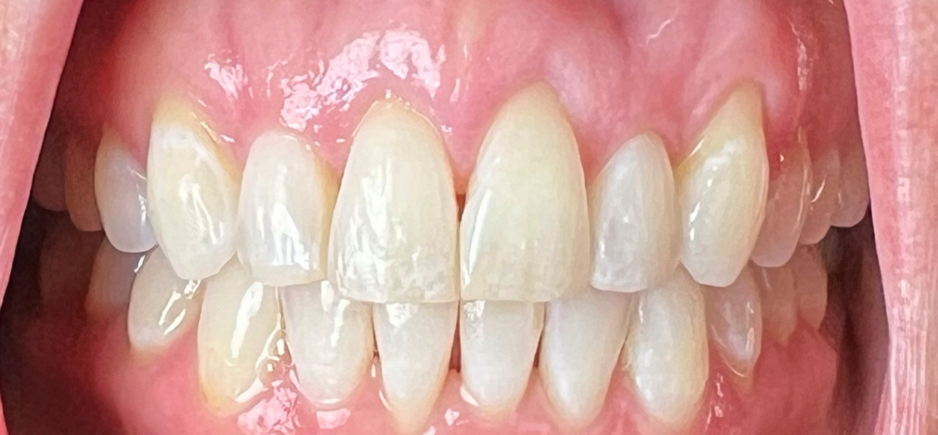 Kierland Dental Studio of Paradise Valley smile makeover after — Scottsdale, AZ