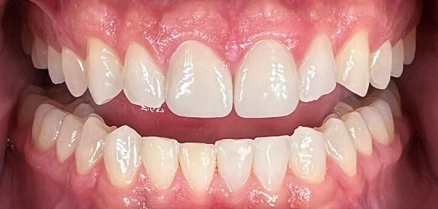 Kierland Dental Studio of Paradise Valley smile makeover after — Scottsdale, AZ