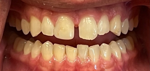 Smile Makeover before at Kierland Dental Studio of Paradise Valley in Scottsdale, AZ
