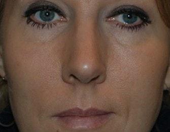 Craig M. Person, MD rhinoplasty after — Greenbelt, MD